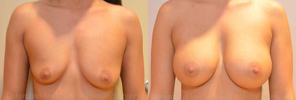 Breast Augmentation before and after photo by Columbus Institute of Plastic Surgery in Columbus, OH