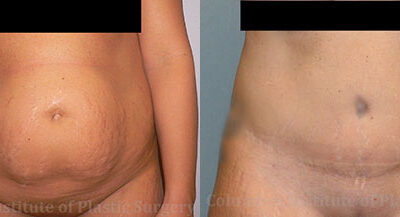 Abdominoplasty (Tummy Tuck) before and after photo by Columbus Institute of Plastic Surgery in Columbus, OH Abdominoplasty (Tummy Tuck) before and after photo by Columbus Institute of Plastic Surgery in Columbus, OH