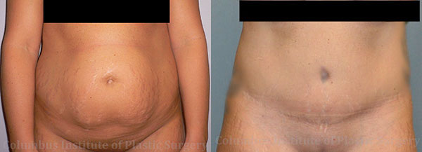 Abdominoplasty (Tummy Tuck) before and after photo by Columbus Institute of Plastic Surgery in Columbus, OH