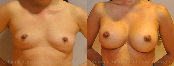 Breast Augmentation before and after photo by Columbus Institute of Plastic Surgery in Columbus, OH