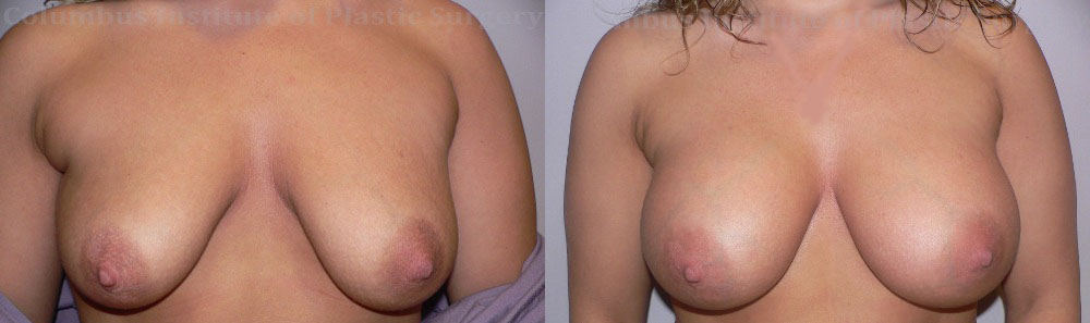 Breast Augmentation – 400cc-500cc before and after photo by Columbus Institute of Plastic Surgery in Columbus, OH