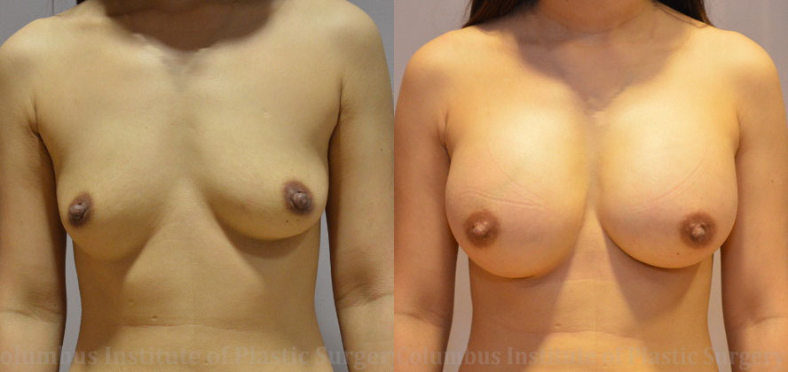 Breast Augmentation – 300cc-400cc before and after photo by Columbus Institute of Plastic Surgery in Columbus, OH