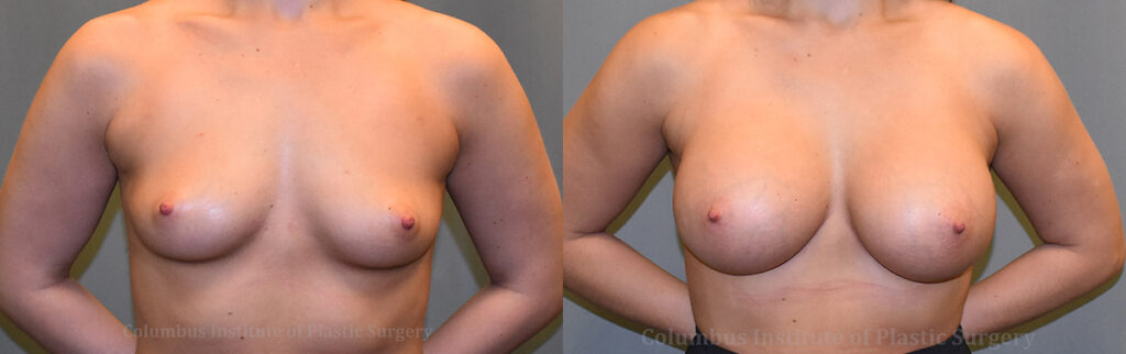 Breast Augmentation before and after photo by Columbus Institute of Plastic Surgery in Columbus, OH
