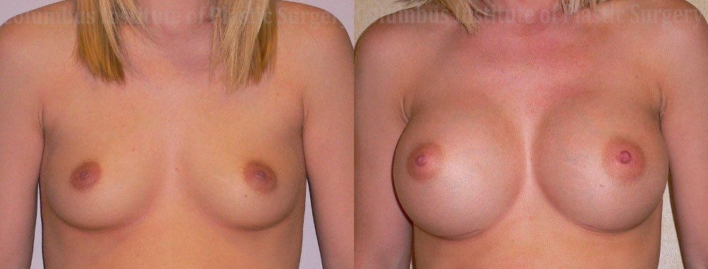 Breast Augmentation – 400cc-500cc before and after photo by Columbus Institute of Plastic Surgery in Columbus, OH