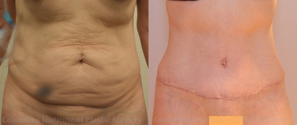 Abdominoplasty (Tummy Tuck) before and after photo by Columbus Institute of Plastic Surgery in Columbus, OH