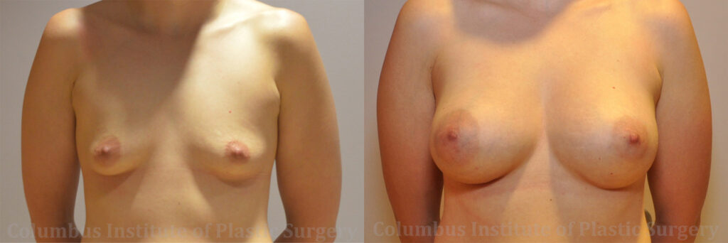 Breast Augmentation before and after photo by Columbus Institute of Plastic Surgery in Columbus, OH