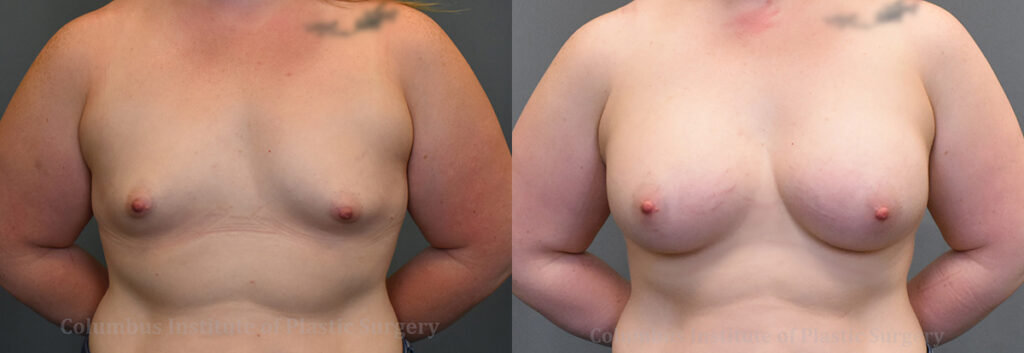 Breast Augmentation – 400cc-500cc before and after photo by Columbus Institute of Plastic Surgery in Columbus, OH