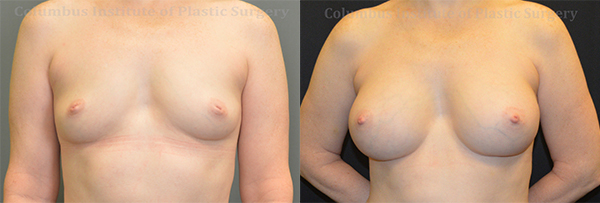 Breast Augmentation before and after photo by Columbus Institute of Plastic Surgery in Columbus, OH