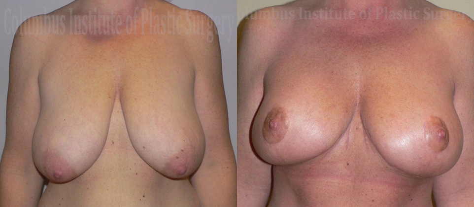Breast Lift (Mastopexy) before and after photo by Columbus Institute of Plastic Surgery in Columbus, OH