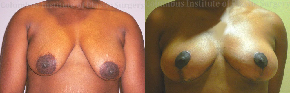 Breast Lift (Mastopexy) before and after photo by Columbus Institute of Plastic Surgery in Columbus, OH