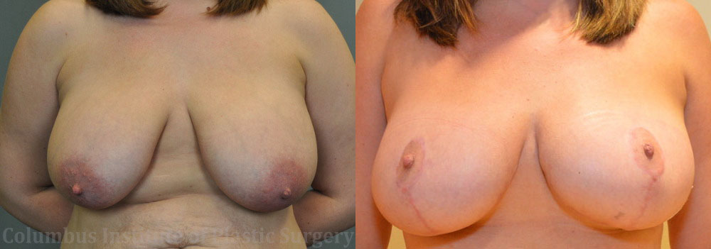 Breast Lift (Mastopexy) before and after photo by Columbus Institute of Plastic Surgery in Columbus, OH