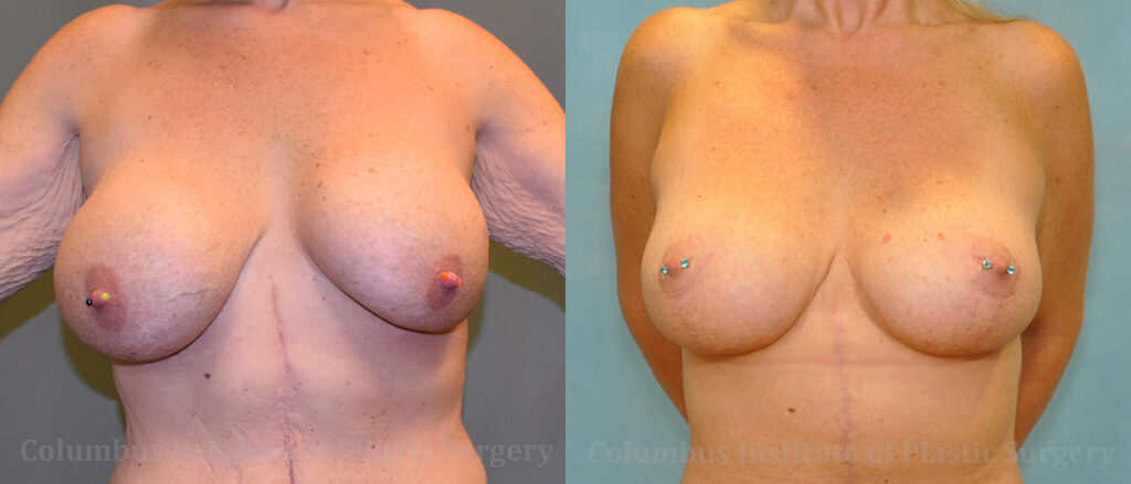 Breast Lift (Mastopexy) before and after photo by Columbus Institute of Plastic Surgery in Columbus, OH