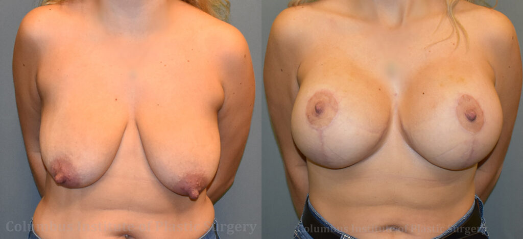 Breast Lift (Mastopexy) before and after photo by Columbus Institute of Plastic Surgery in Columbus, OH