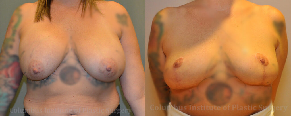Breast Lift (Mastopexy) before and after photo by Columbus Institute of Plastic Surgery in Columbus, OH