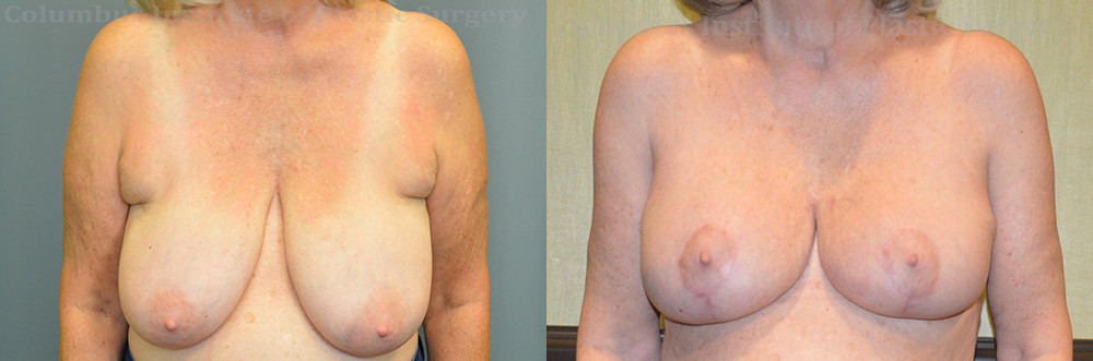 Breast Lift (Mastopexy) before and after photo by Columbus Institute of Plastic Surgery in Columbus, OH