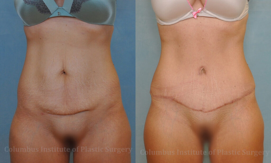 Abdominoplasty (Tummy Tuck) before and after photo by Columbus Institute of Plastic Surgery in Columbus, OH