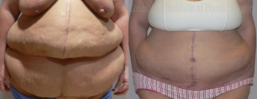 Abdominoplasty after Weight Loss before and after photo by Columbus Institute of Plastic Surgery in Columbus, OH