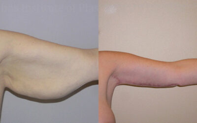 Brachioplasty (Arm Lift) before and after photo by Columbus Institute of Plastic Surgery in Columbus, OH Brachioplasty (Arm Lift) before and after photo by Columbus Institute of Plastic Surgery in Columbus, OH