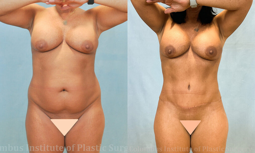 Liposuction before and after photo by Columbus Institute of Plastic Surgery in Columbus, OH