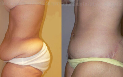 Belt Lipectomy before and after photo by Columbus Institute of Plastic Surgery in Columbus, OH Belt Lipectomy before and after photo by Columbus Institute of Plastic Surgery in Columbus, OH