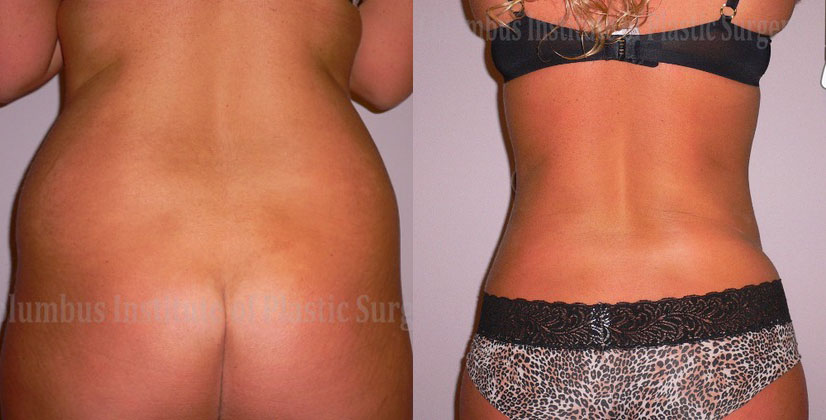 Liposuction before and after photo by Columbus Institute of Plastic Surgery in Columbus, OH