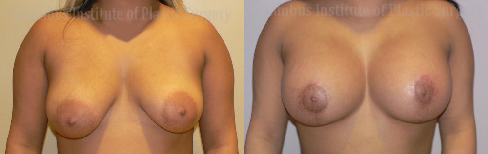 Breast Lift and Augmentation (Implants) before and after photo by Columbus Institute of Plastic Surgery in Columbus, OH
