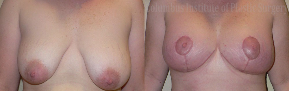 Breast Lift and Augmentation (Implants) before and after photo by Columbus Institute of Plastic Surgery in Columbus, OH