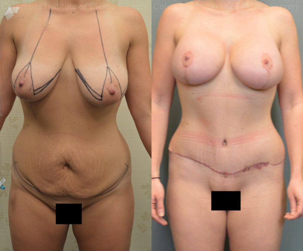Breast Lift and Augmentation (Implants) before and after photo by Columbus Institute of Plastic Surgery in Columbus, OH