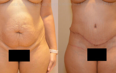 Abdominoplasty (Tummy Tuck) before and after photo by Columbus Institute of Plastic Surgery in Columbus, OH Abdominoplasty (Tummy Tuck) before and after photo by Columbus Institute of Plastic Surgery in Columbus, OH