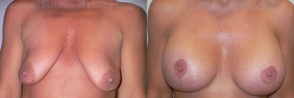 Breast Lift with Augmentation after Weight Loss before and after photo by Columbus Institute of Plastic Surgery in Columbus, OH
