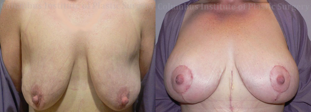 Breast Lift with Augmentation after Weight Loss before and after photo by Columbus Institute of Plastic Surgery in Columbus, OH
