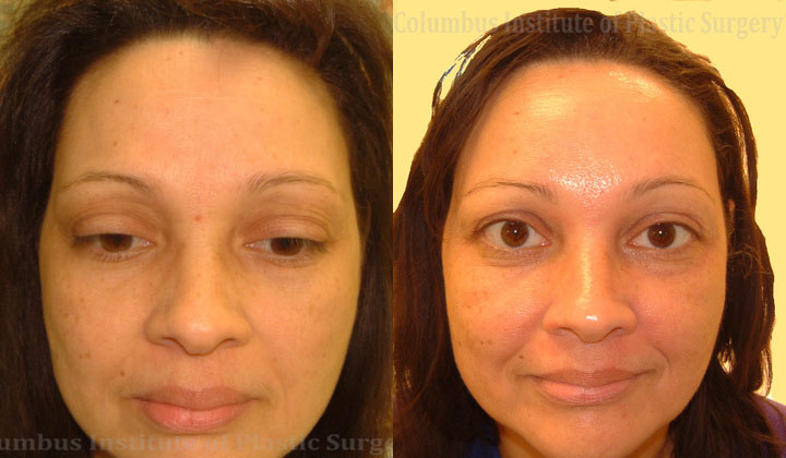 Browlift before and after photo by Columbus Institute of Plastic Surgery in Columbus, OH