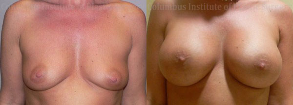 Breast Augmentation before and after photo by Columbus Institute of Plastic Surgery in Columbus, OH