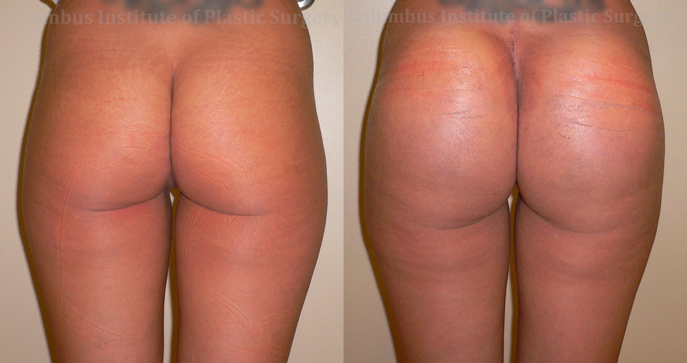 Buttock (Gluteal) Augmentation with Implants before and after photo by Columbus Institute of Plastic Surgery in Columbus, OH