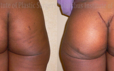 Buttock (Gluteal) Augmentation with Implants before and after photo by Columbus Institute of Plastic Surgery in Columbus, OH Buttock (Gluteal) Augmentation with Implants before and after photo by Columbus Institute of Plastic Surgery in Columbus, OH