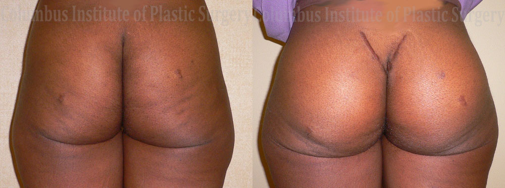 Buttock (Gluteal) Augmentation with Implants before and after photo by Columbus Institute of Plastic Surgery in Columbus, OH