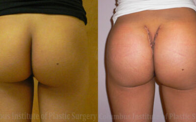 Buttock (Gluteal) Augmentation with Implants before and after photo by Columbus Institute of Plastic Surgery in Columbus, OH Buttock (Gluteal) Augmentation with Implants before and after photo by Columbus Institute of Plastic Surgery in Columbus, OH