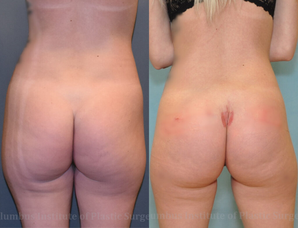 Buttock (Gluteal) Augmentation with Implants before and after photo by Columbus Institute of Plastic Surgery in Columbus, OH