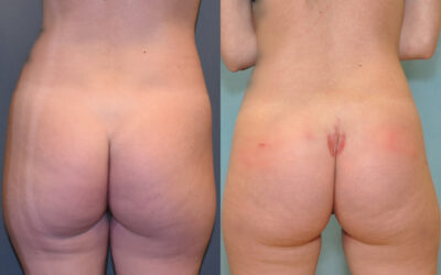 Buttock (Gluteal) Augmentation with Implants before and after photo by Columbus Institute of Plastic Surgery in Columbus, OH Buttock (Gluteal) Augmentation with Implants before and after photo by Columbus Institute of Plastic Surgery in Columbus, OH