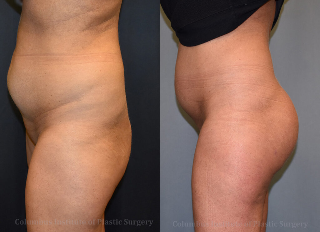 Buttock (Gluteal) Augmentation with Implants before and after photo by Columbus Institute of Plastic Surgery in Columbus, OH
