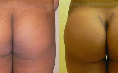 Buttock (Gluteal) Augmentation with Implants before and after photo by Columbus Institute of Plastic Surgery in Columbus, OH Buttock (Gluteal) Augmentation with Implants before and after photo by Columbus Institute of Plastic Surgery in Columbus, OH