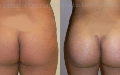Buttock (Gluteal) Augmentation with Implants before and after photo by Columbus Institute of Plastic Surgery in Columbus, OH Buttock (Gluteal) Augmentation with Implants before and after photo by Columbus Institute of Plastic Surgery in Columbus, OH