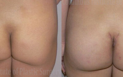 Buttock (Gluteal) Augmentation with Implants before and after photo by Columbus Institute of Plastic Surgery in Columbus, OH Buttock (Gluteal) Augmentation with Implants before and after photo by Columbus Institute of Plastic Surgery in Columbus, OH