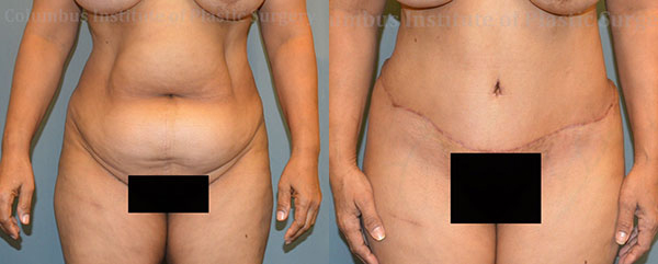 Abdominoplasty (Tummy Tuck) before and after photo by Columbus Institute of Plastic Surgery in Columbus, OH