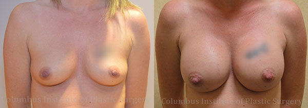 Breast Augmentation before and after photo by Columbus Institute of Plastic Surgery in Columbus, OH