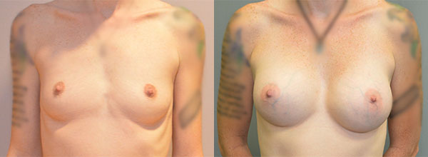 Breast Augmentation – 300cc-400cc before and after photo by Columbus Institute of Plastic Surgery in Columbus, OH