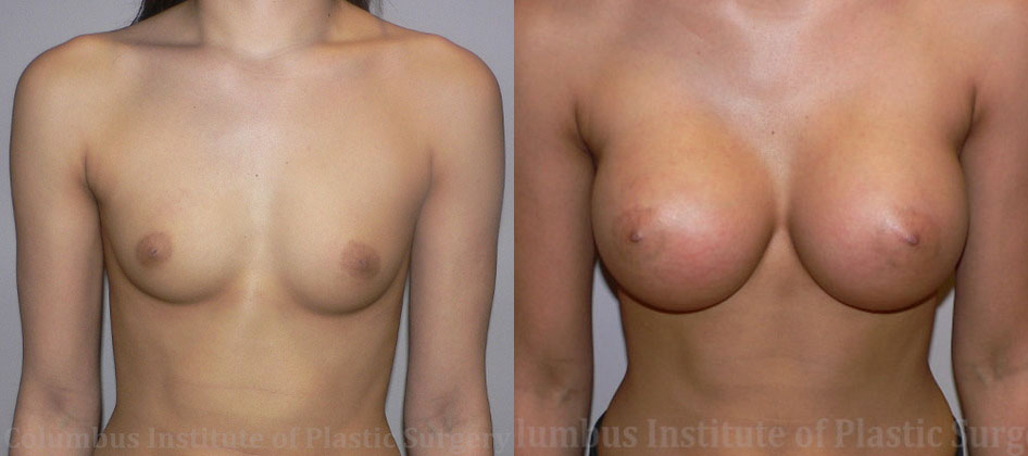 Breast Augmentation – 400cc-500cc before and after photo by Columbus Institute of Plastic Surgery in Columbus, OH