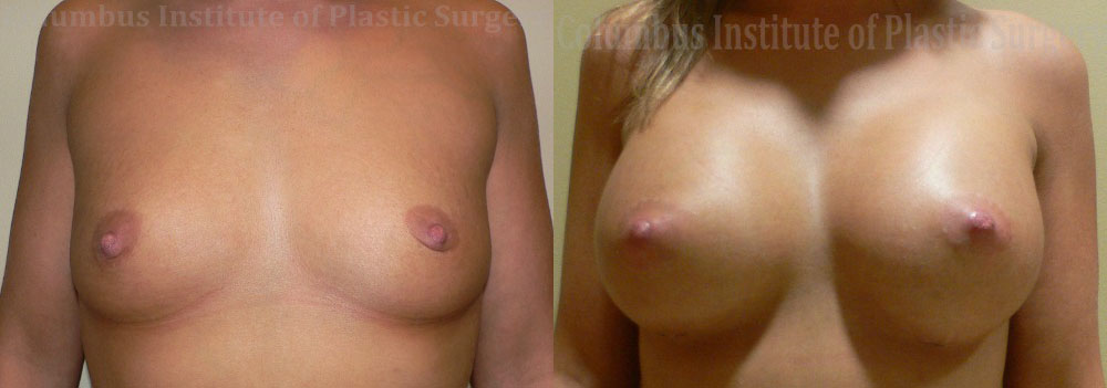 Breast Augmentation before and after photo by Columbus Institute of Plastic Surgery in Columbus, OH