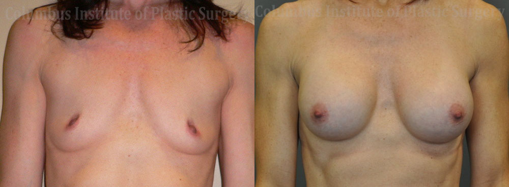 Breast Augmentation – 400cc-500cc before and after photo by Columbus Institute of Plastic Surgery in Columbus, OH
