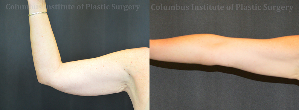 CoolSculpting before and after photo by Columbus Institute of Plastic Surgery in Columbus, OH